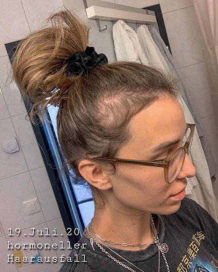 Die Schweizer Influencerin Anja Zeidler zeigte ein halbes Jahr nach der Geburt ihrer Tochter ihren Haarausfall und nachwachsenden Härchen.