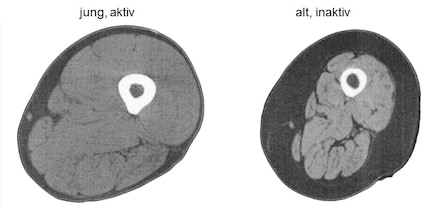 Magnetresonanzbilder durch die Oberschenkelmitte eines 25-jährigen gesunden Erwachsenen (links) und eines 75-jährigen gesunden Erwachsenen (rechts), die eine Sarkopenie zeigt. Man beachte die geringere Muskelmasse (hellgrau), das grössere subkutane Fett (dunkelgrau) und das erhöhte intramuskuläre Fett (dunkelgraue Linien) im Bein des älteren Teilnehmers. Adaptiert von [32].