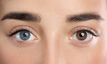 Twee-kleurige blik: De melanineconcentratie is groter in het bruine oog.