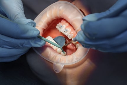 Braces kunnen snel erg duur worden. Een verzekering kan uitkomst bieden.
